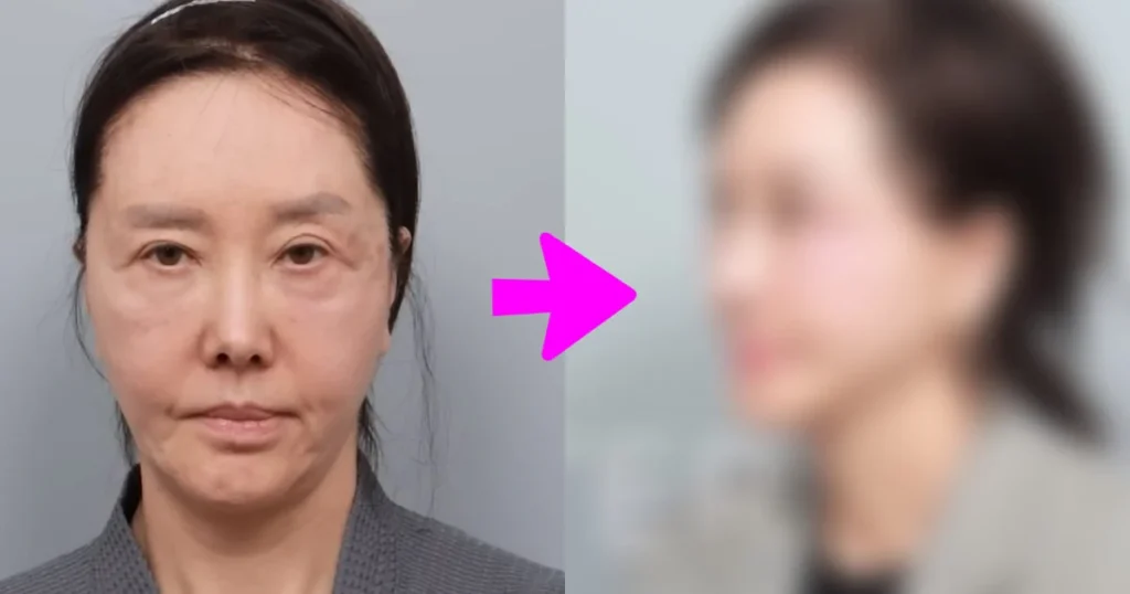 61-Year-Old Actress Shocks With New Face After Cosmetic Procedures.